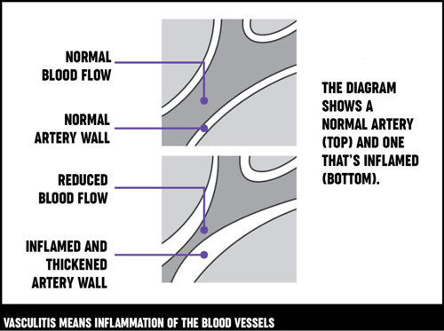 How vasculitis affects an artery