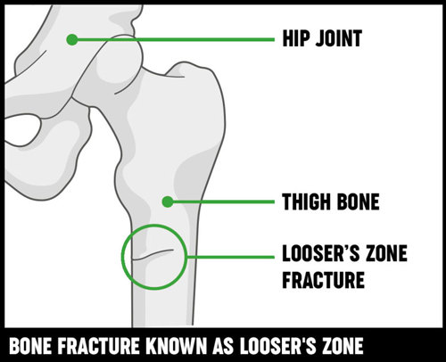 picture of where kidney pain is felt