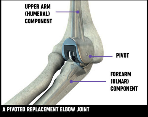 Shoulder and elbow replacement | Versus Arthritis