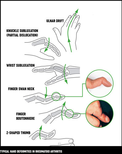 An illustration of typical hand deformities that can be caused by rheumatoid arthritis.
