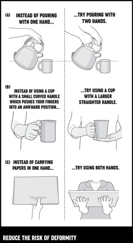 An illustration on how to hold everyday objects to reduce the risk of deformity.