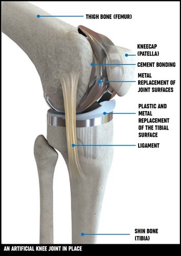 Knee replacement surgery | Treatment options | Versus Arthritis