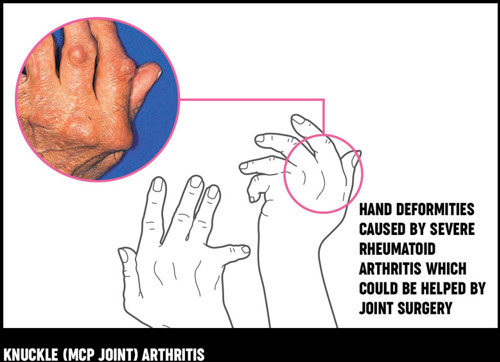 hand and wrist surgery treatment options versus arthritis