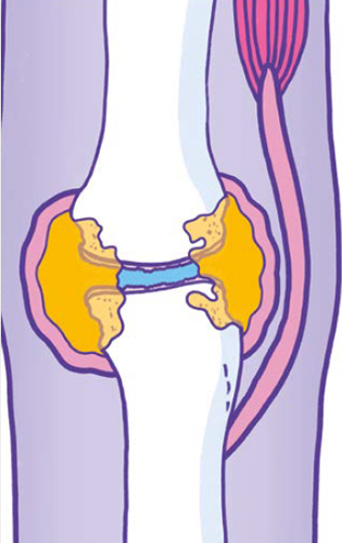 Diagrammatic representation of an index finger MCP joint affected by rheumatoid arthritis.