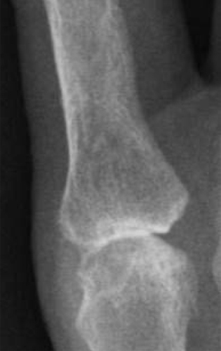X-ray of an index finger MCP joint affected by osteoarthritis.
