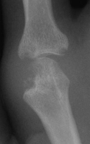 X-ray of an index finger MCP joint affected by rheumatoid arthritis.