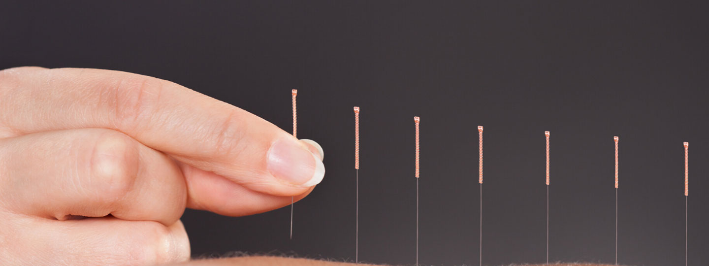 A person putting acupuncture needles in.