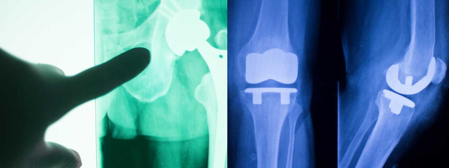 Looking at an x-ray of a hip and knee replacement.