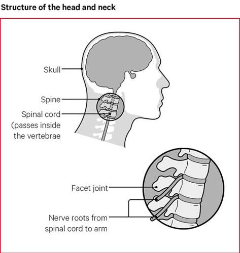 Neck pain | Causes, exercises, treatments | Versus Arthritis