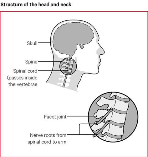 Neck Pain Causes Exercises Treatments Versus Arthritis Neck Pain Causes Exercises Treatments Versus Arthritis
