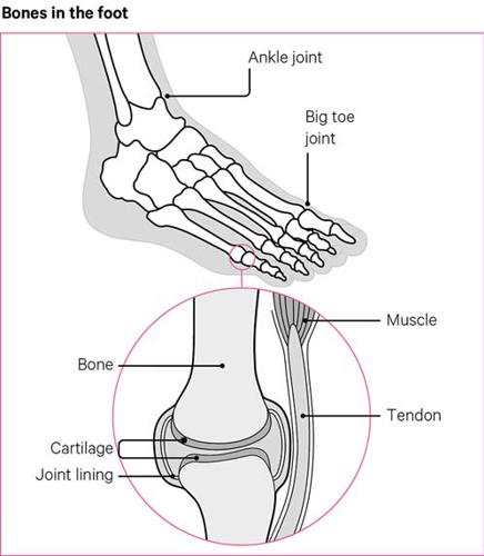 Osteoarthritis Oa Of The Foot And Ankle Versus Arthritis