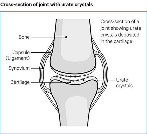 The urate crystals sit within the cartilage of the joint which causes the pain of gout.