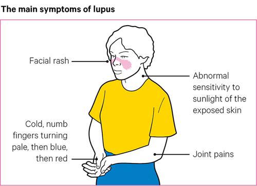 lupus erythematosus arthralgia