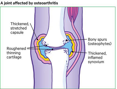 osteoarthritis knee lump erőemelő vállfájdalom