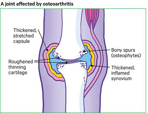 osteoarthritis arthrosis osteoarthrosis arthrosis kezelése)