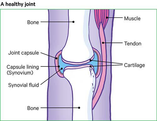 Ein gesundes Gelenk ohne Schäden an Knochen, Knorpel oder Synovialmembran.