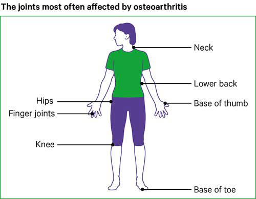 koksz a csípőízület osteoarthritis je 2 fok