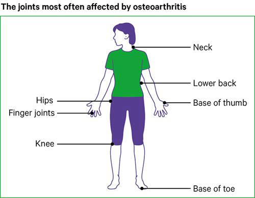 koksz a csípőízület osteoarthritis je 2 fok)