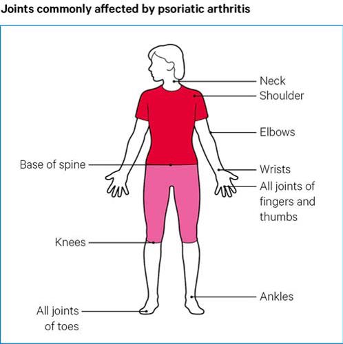 Psoriatic arthritis | Psoriatic arthritis | Causes, symptoms, treatments Psoriatic arthritis | Psoriatic arthritis | Causes, symptoms, treatments