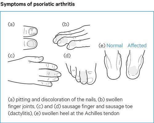 psoriatic arthritis diet)