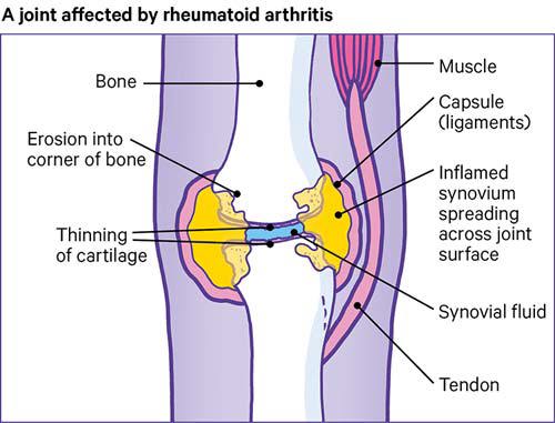 Rheumatoid Arthritis Stages And Progression