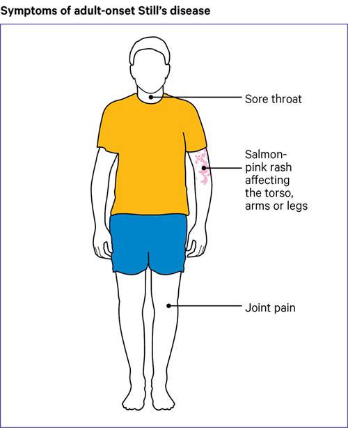 Symptoms of Adult-onset Still’s disease