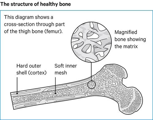 Osteomalacia Causes Symptoms Treatment Versus Arthritis