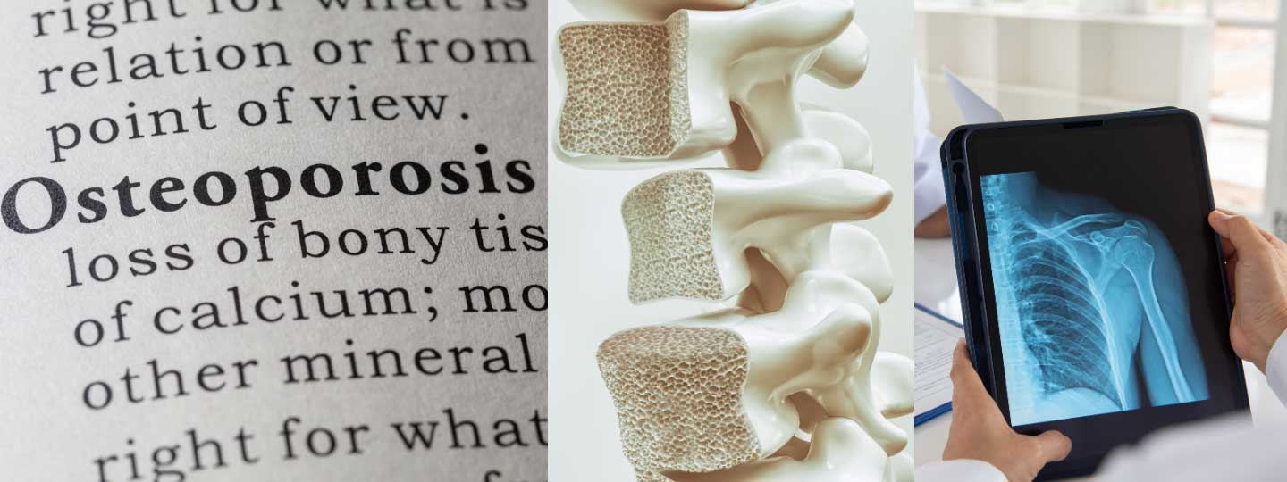 Definition of osteoporosis, a section of spine and an x-ray.