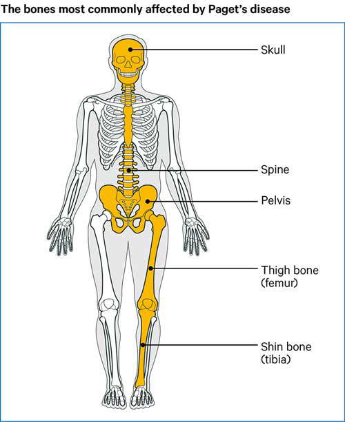 Paget's disease of bone | Causes, symptoms, treatments