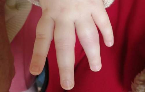 Mia's hand which has swollen fingers