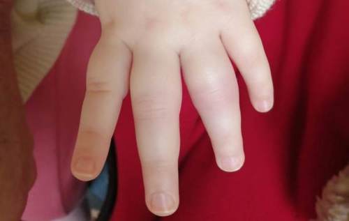 Mia's hand which has swollen fingers